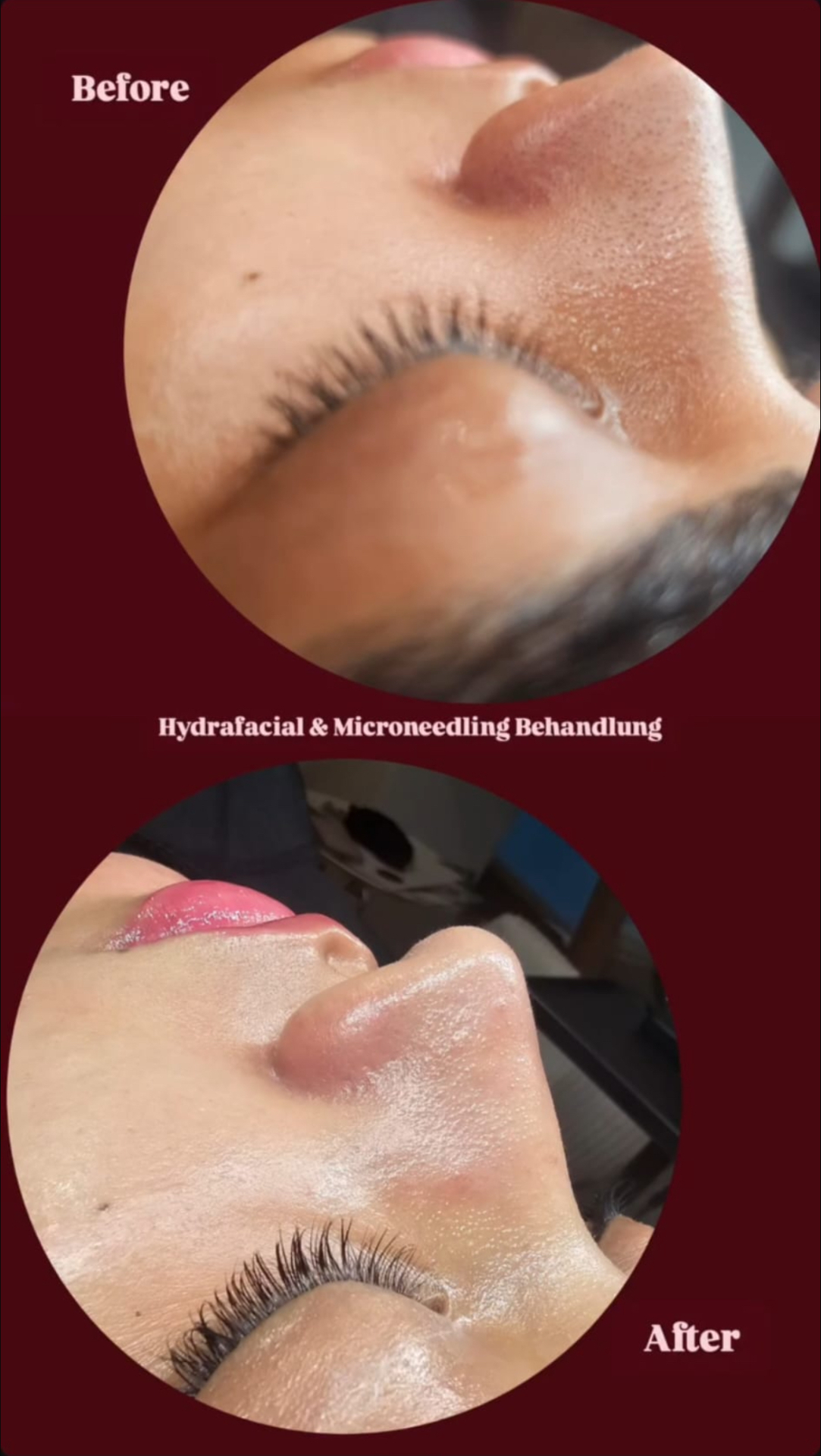 Hydrafacial & Microneedling – Vorher-Nachher Ergebnis, Valora Medical Center Leipzig