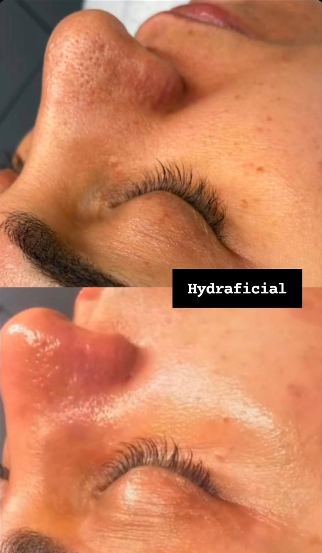 Hydrafacial – Vorher-Nachher Ergebnis, Valora Medical Center Leipzig