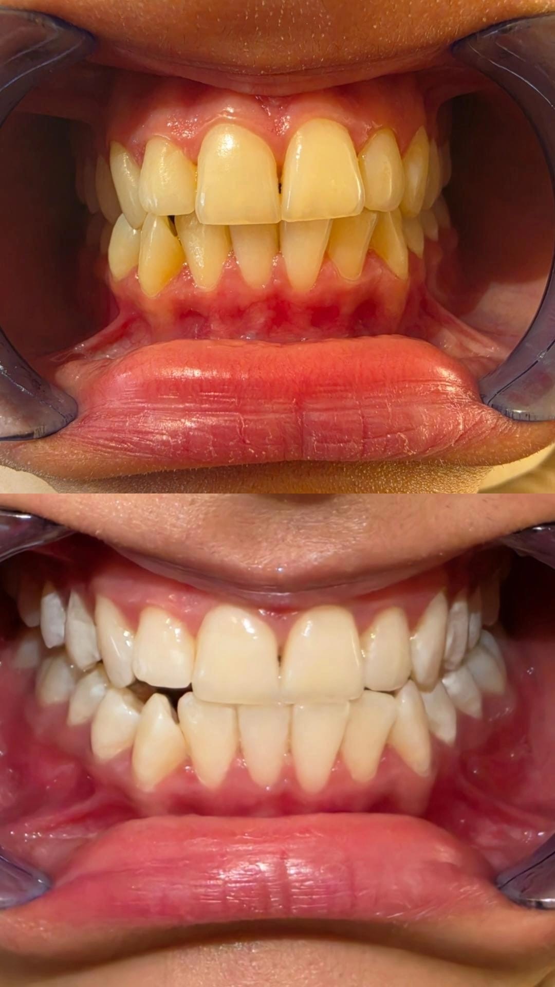 Zahnbleaching – Vorher-Nachher Ergebnis, Valora Medical Center Leipzig