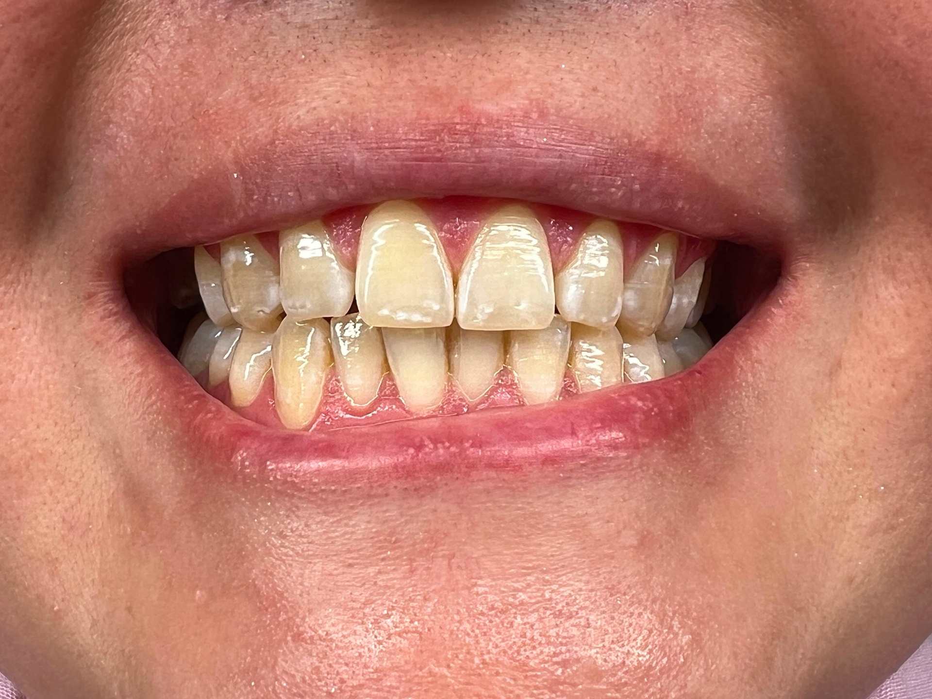 Nachher – Zahnbleaching, Behandlung im Valora Medical Center Leipzig